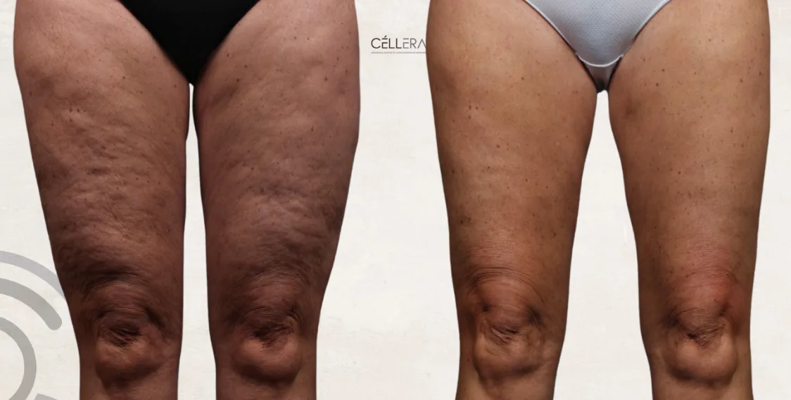 Tratamiento Celulitis