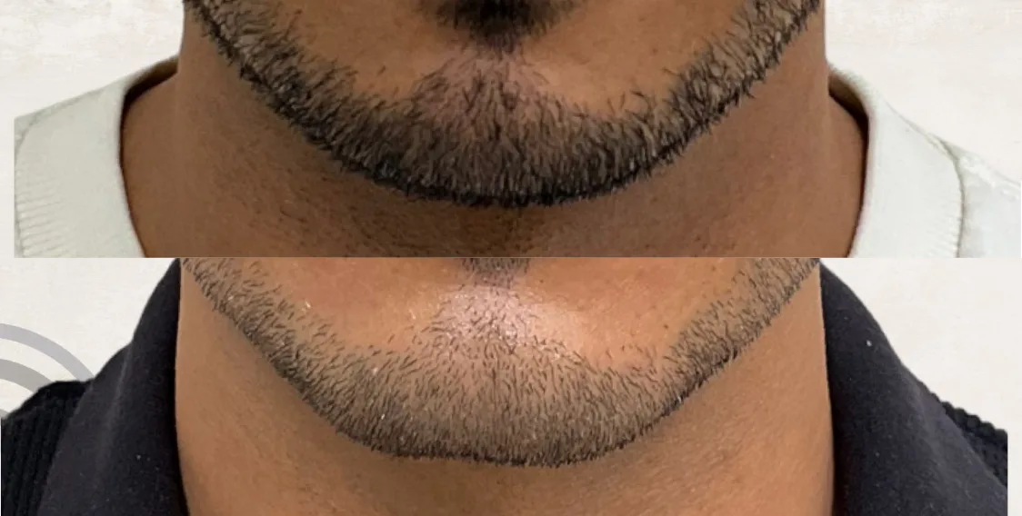 Chin Filler